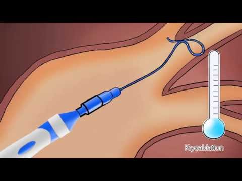 Symptome von Gelenkschmerzen nach verweigerten Beinen zu sein Volksmedizin Osteoarthritis des Knies deformiert