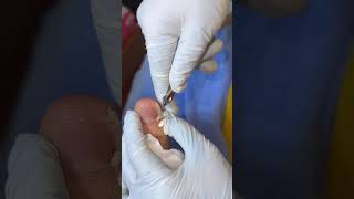 Ep_8187 Foot nail skin removal 👣 Seeing the depth..feels tingling 😄 (clip from Thailand)
