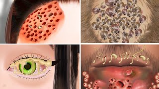 ASMR Series: Animated Treatment for Blackheads and Pimples on the Face