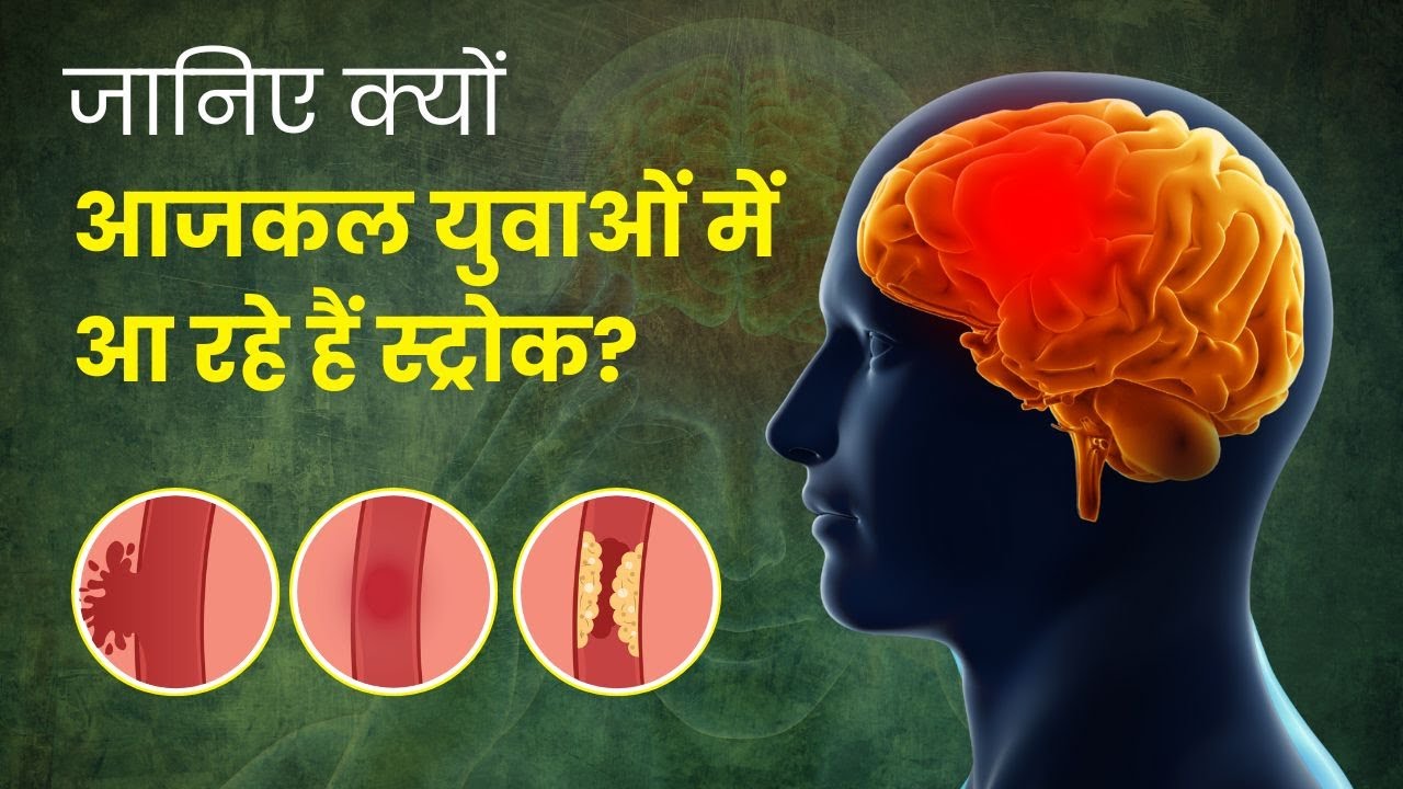 Why are More Young People Getting Strokes Expert Insights by Dr P T Acharya OnlyMyHealth