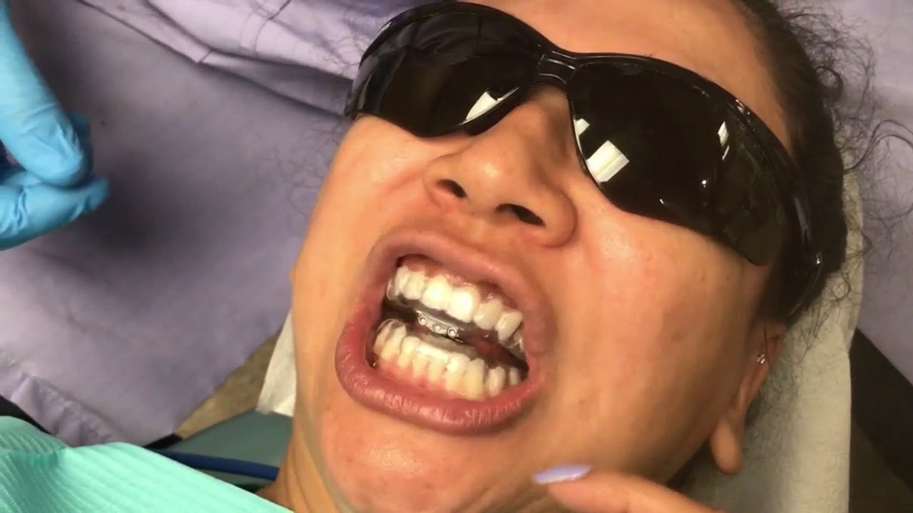 Sleep Apnea Tap3 Device