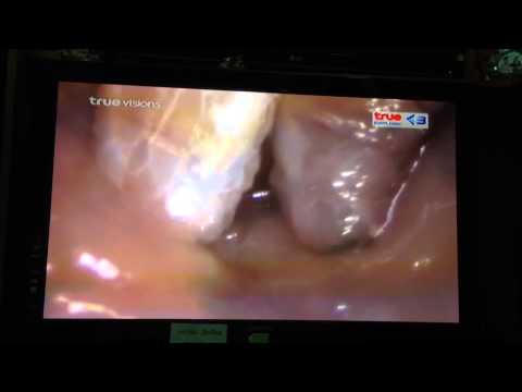 Erysipelatous กลากมัน แคปซูลน้ำมันแฟลกซ์สำหรับโรคสะเก็ดเงิน