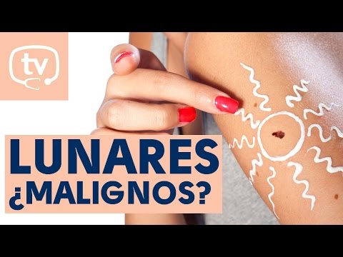 Cómo saber si un lunar es maligno