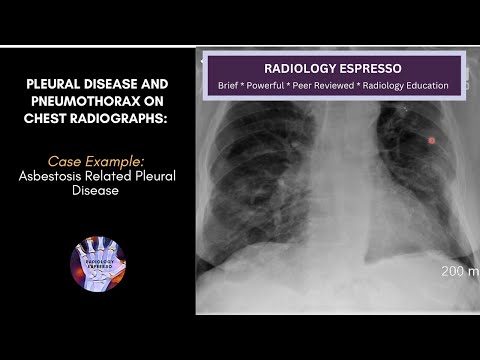 PLEURAL DISEASE & PNEUMOTHORAX ON CHEST RADIOGRAPHS: Case Example-Asbestosis Related Pleural Disease