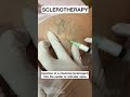 Sclerotherapy for Spider and Varicose Veins #Shorts