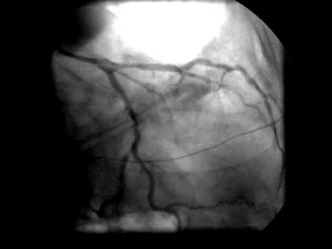 A térd ízületi rendellenességével kapják-e őket, Ízületi fájdalom osteochondrosis miatt