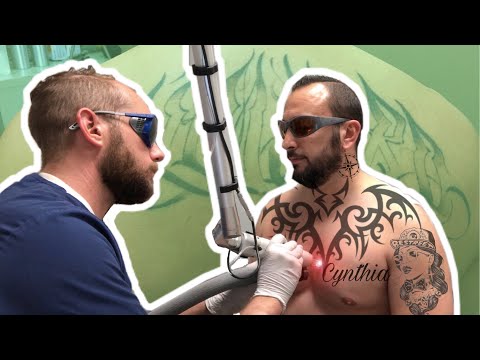 Laser Tattoo Removal | Vibepedia