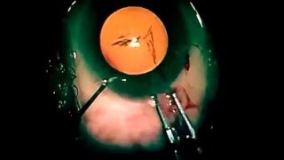 preview picture of video 'Cataract Surgery - Dr. Basha, Fraser Eye (Warren, Michigan)'