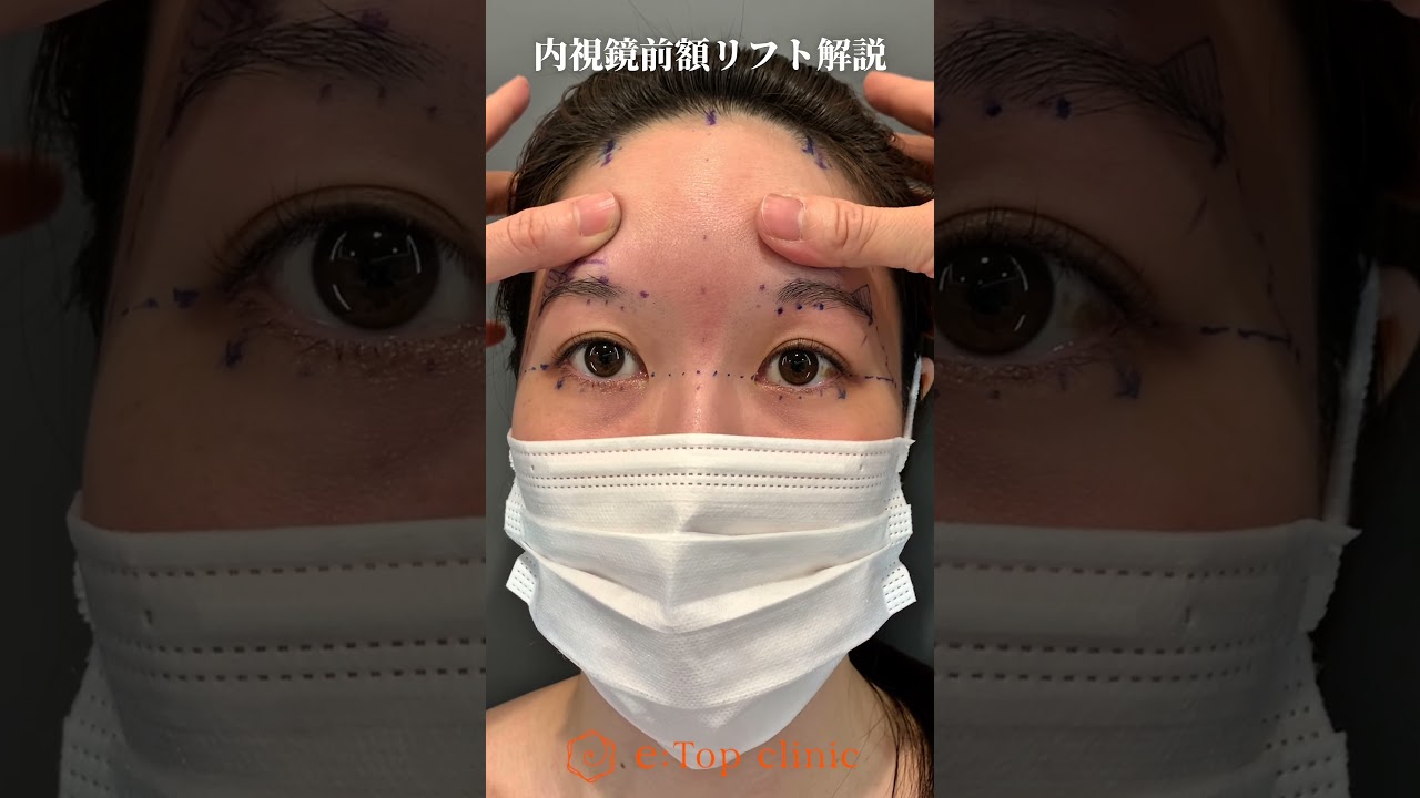 眉下リフトと内視鏡どっちが適応？