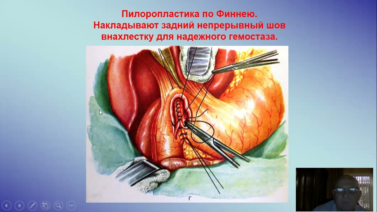 Тактика лечения язвенной болезни (опер лечение)