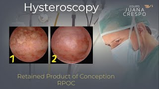 Retained Product of Conception (Hysteroscopic Scissors)