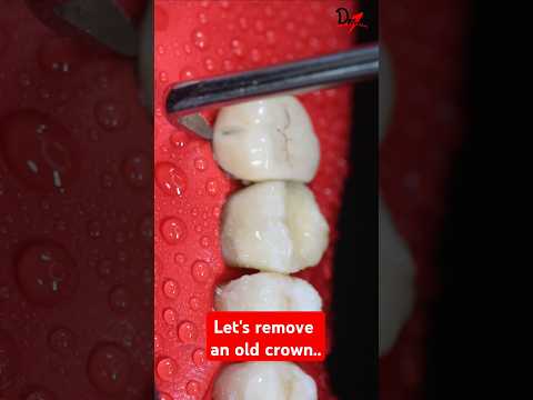 Its time for a new Dental Crown! #ASMR