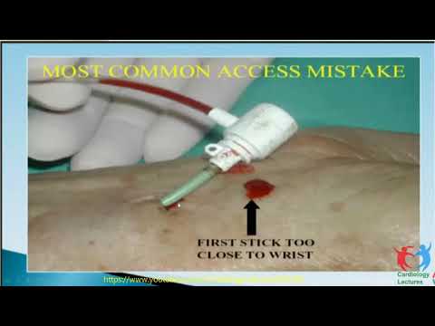 Difficult Radial Anatomy in Coplex PCI