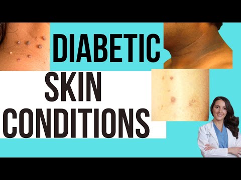 Diabetes Skin Conditions! Signs You May Have Diabetes