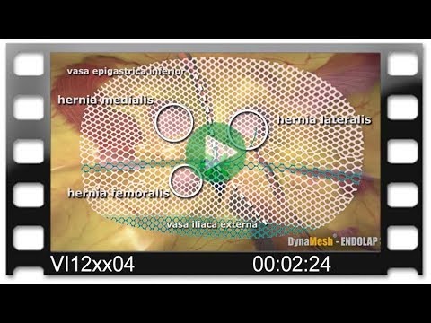 DynaMesh®-ENDOLAP 3D - Animation: Total Extraperitoneal Endoscopic Hernioplasty (TEP)