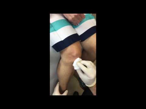 Anterior knee injection with Steroid for OA