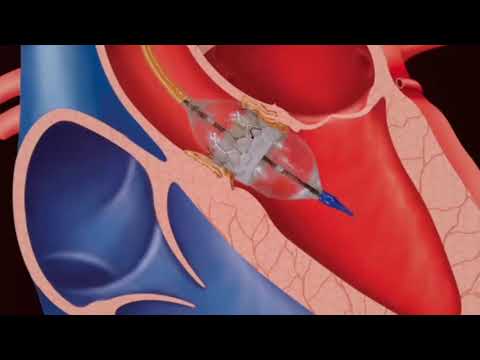 Landmark TAVI TAVR Procedure by Dr. Keyur Parikh, Dr. Dhiren Shah at CIMS Hospital by Cardiac Team