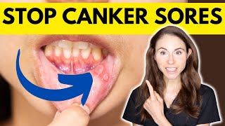 9 Tips To Prevent Canker Sores