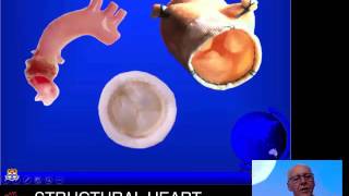 Pulmonary valve replacement: who & how – Prof Richard Chard