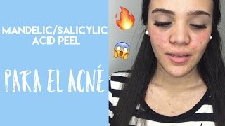 ME HAGO UN PEELING QUÍMICO CON ÁCIDO EN CASA | DÍA 1