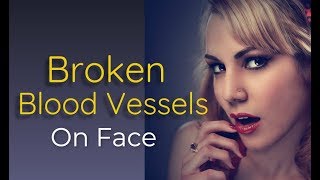 Broken Blood Vessels On Face,  Causes, Symptoms And Treatments