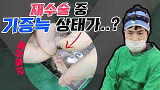 코재수술 기증늑 꺼내보니 상태가..? ????리얼상황