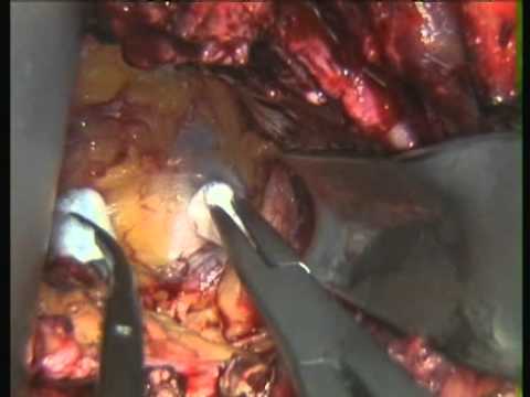 Radical Perineal Prostatectomy And Extended Pelvic Nodes Surgery