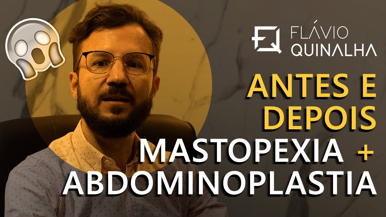MASTOPEXIA + ABDOMINOPLASTIA - ANTES E DEPOIS!