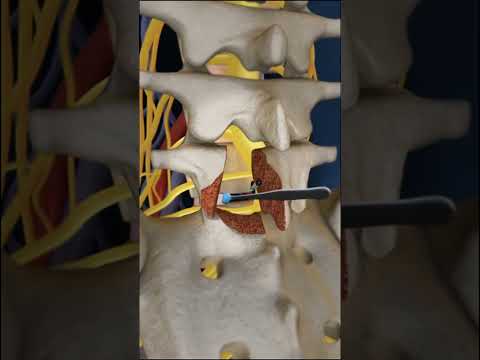 Lumbar Fusion of L5 S1 Animation
