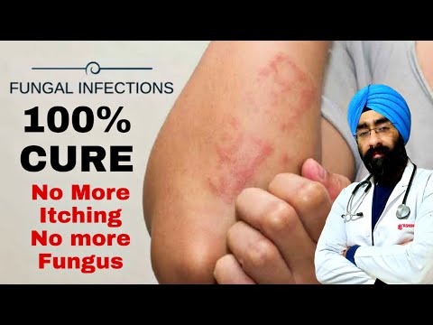 Best Treatment of Fungal Skin Infections | Expert Advice | Dr.Education (ENG)