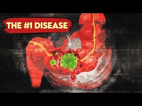 The #1 Disease More Common than Heart Disease and Cancer
