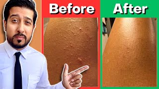 How to Get Rid of Keratosis Pilaris, Chicken Skin, and Strawberry Legs