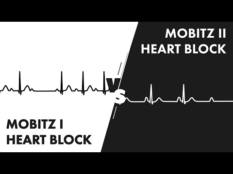 Mobitz Type I vs Type II Second Degree Heart Block