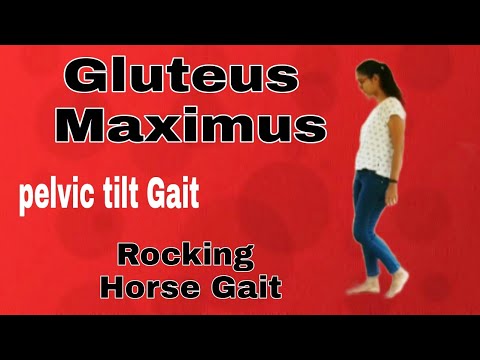 Gluteus Maximus Gait || Pelvic Tilt Gait || Rocking Horse Gait