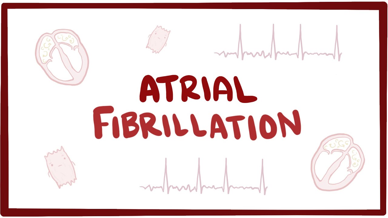 Atrial fibrillation (A-fib, AF) - causes, symptoms, treatment & pathology