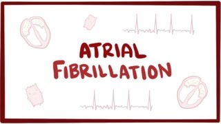 Atrial fibrillation (A-fib, AF) - causes, symptoms, treatment &amp; pathology