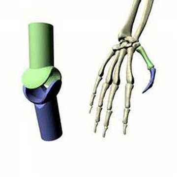 Behandlung von Arthritis des Gelenkes Gelenkentlastung