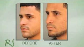 Rhinoplasty Experience of Dr. Nassif's Patient Max