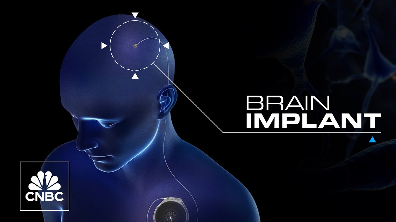 Could brain implants help patients speak again?
