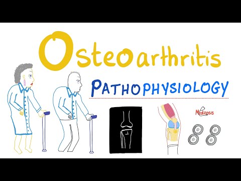 Futó térd osteochondrozis