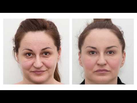 download lagu mp3 mp4 Facial Aesthetic Clinic London, download lagu Facial Aesthetic Clinic London gratis, unduh video klip Facial Aesthetic Clinic London