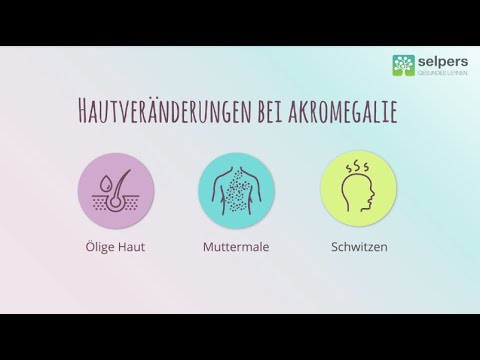 Akren vergrößert – Krankheitsbild der Akromegalie