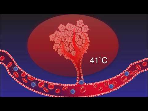 How Hyperthermia jumpstarts the Immune Modulation Effect to Fight Cancer