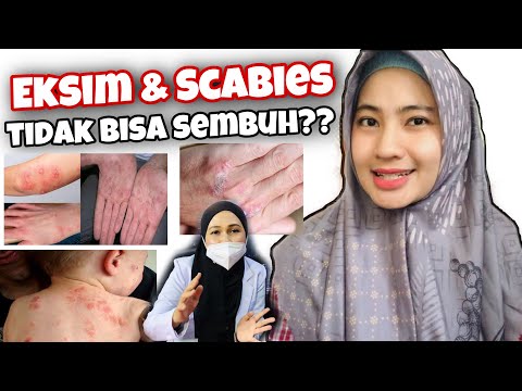 Apakah Eksim & Scabies Bisa Sembuh Total? || Penyebab? Pencegahan?