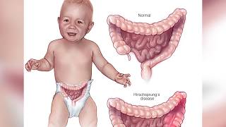 Doctors Remove 30 Pounds Of Poop From Man’s Colon