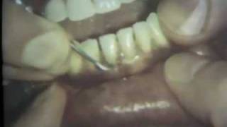Scaling and Root Planing: Part II Mandibular Teeth
