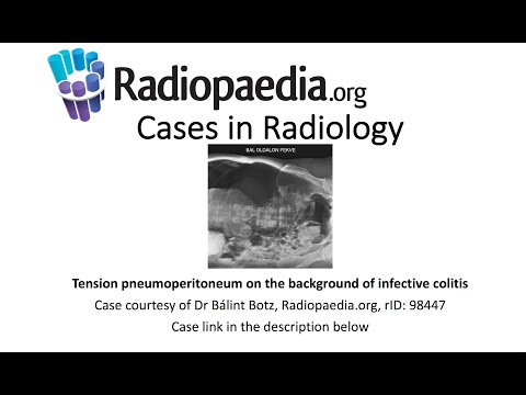 Tension pneumoperitoneum on the background of infective colitis (Radiopaedia.org) Cases in Radiology
