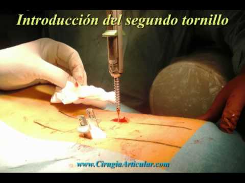 Dolor osteocondrosis en los huesos pélvicos Dolor en la parte baja del abdomen a la izquierda permite al giro