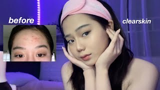 HOW I GET RID OF MY BREAKOUTS using affordable korean skincare from Watsons!