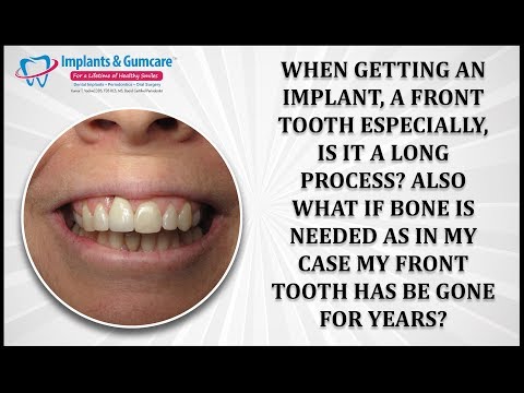How long does the implant process take with bone loss?